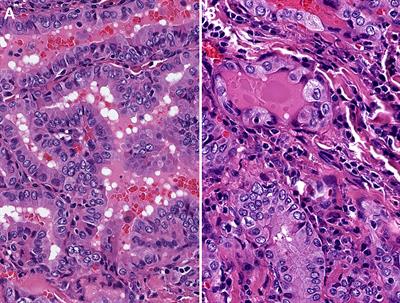 Oncocytic Papillary Thyroid Carcinoma and Oncocytic Poorly Differentiated Thyroid Carcinoma: Clinical Features, Uptake, and Response to Radioactive Iodine Therapy, and Outcome